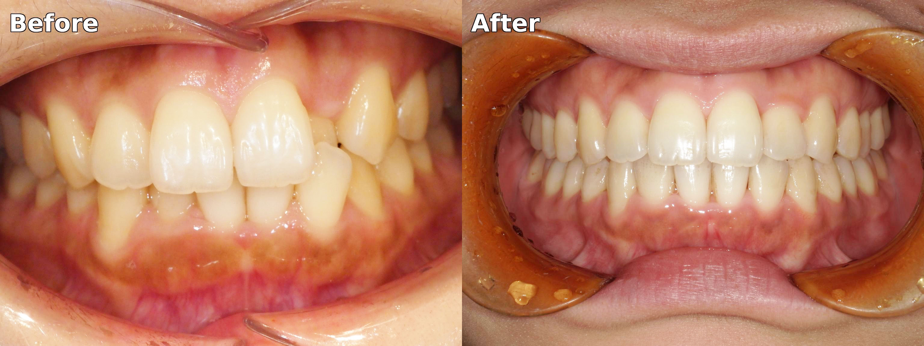 マウスピース矯正の症例