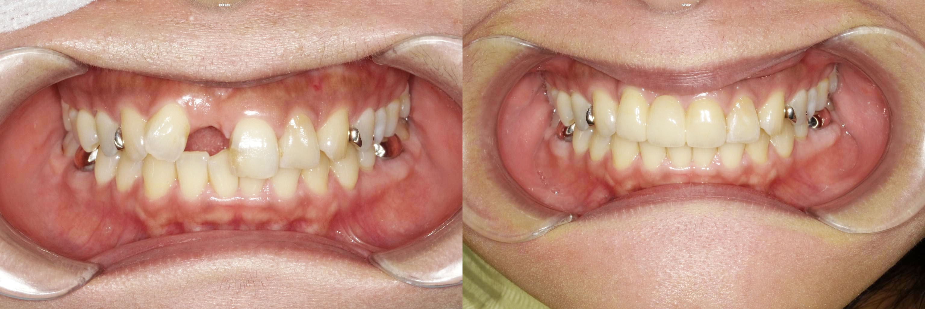 セラミックを用いた補綴の症例