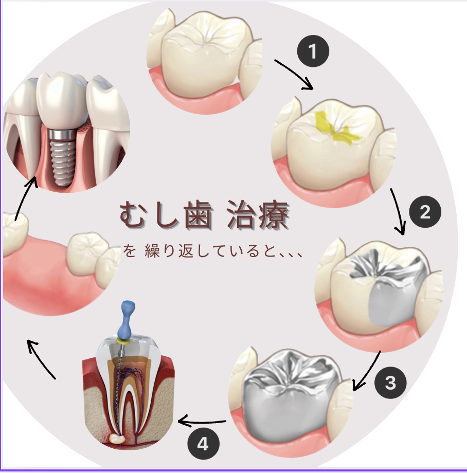 虫歯の再治療に限度があることをご存知ですか？