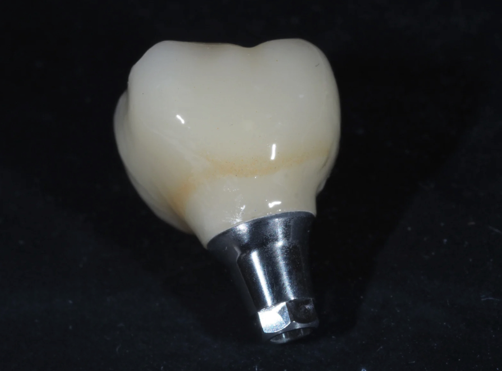 インプラントとは？治療の基本を知ろう