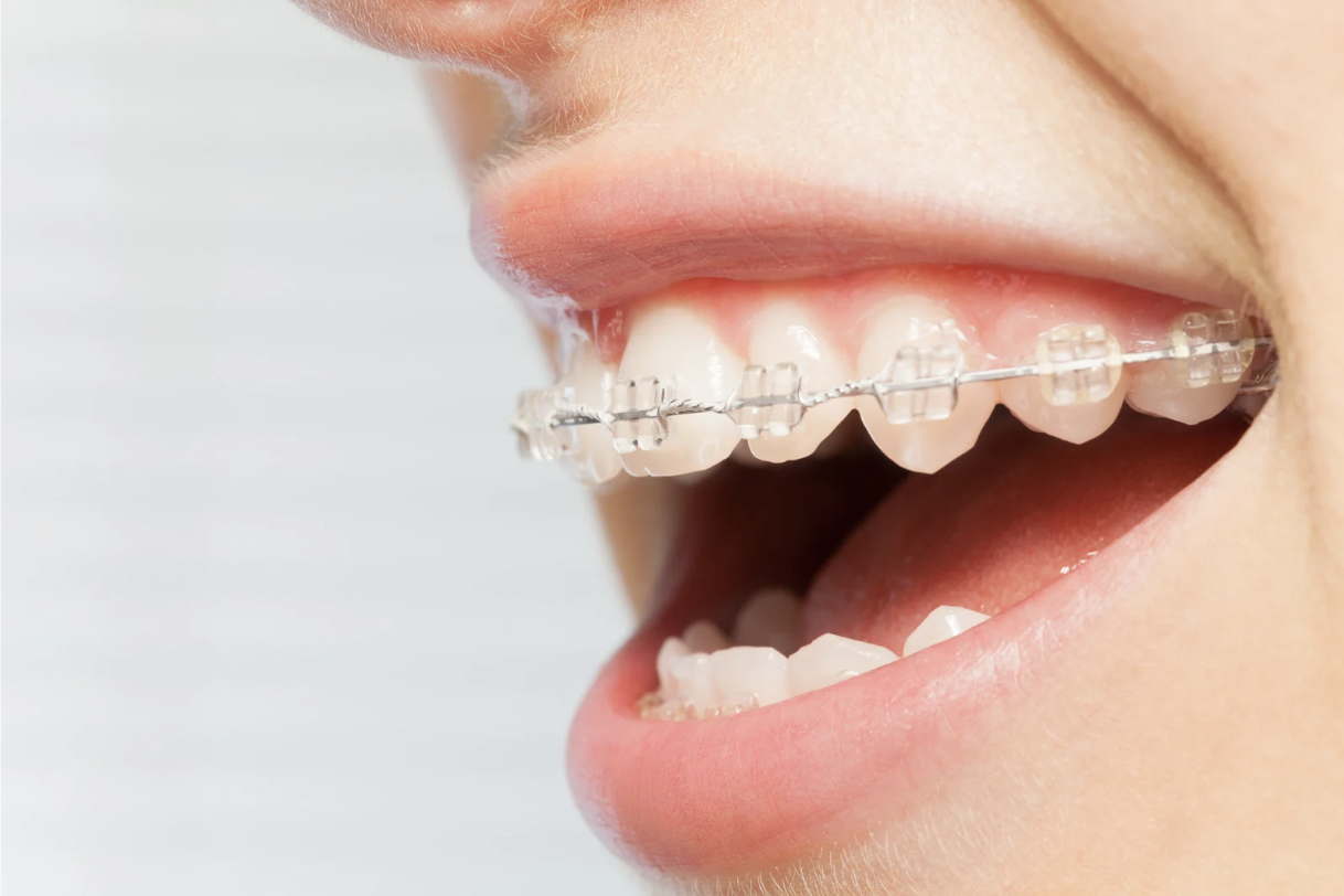 矯正治療と歯周病予防の深い関係